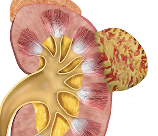 Angiomyolipoma Understand Causes And Symptoms